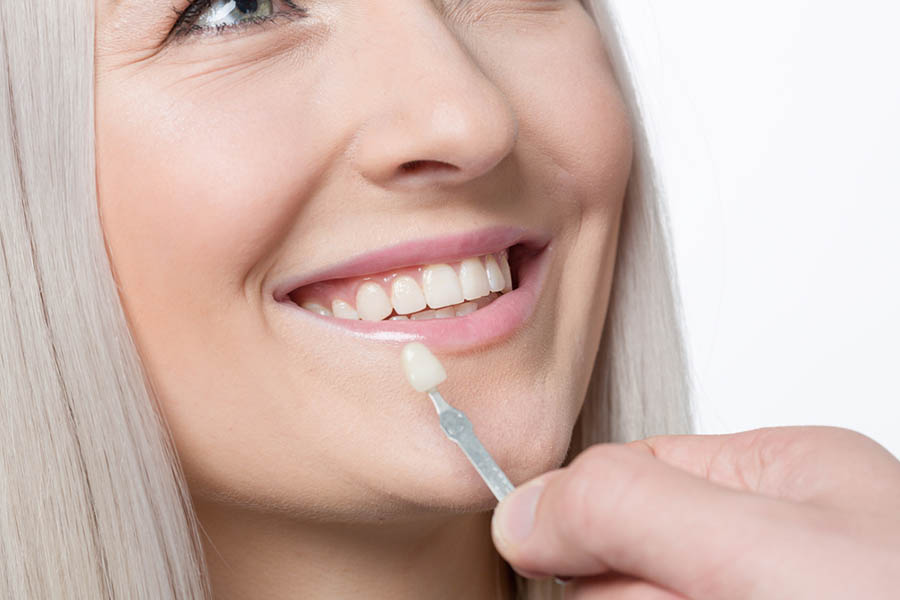 Tutto quello che devi sapere sulle faccette dentali estetiche