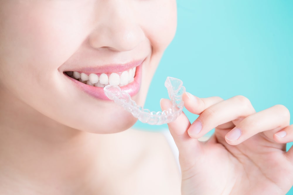 dettaglio del sorriso di una ragazza che avvicina alla bocca una mascherina trasparente per allineare i denti